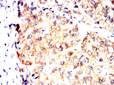 Figure 6:Immunohistochemical analysis of paraffin-embedded liver cancer tissues using SV2C mouse mAb with DAB staining.