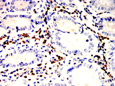 Figure 5:Immunohistochemical analysis of paraffin-embedded gastric cancer tissues using ITGB7 mouse mAb with DAB staining.