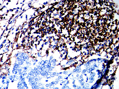 Figure 7:Immunohistochemical analysis of paraffin-embedded gastric cancer tissues using CD180 mouse mAb with DAB staining.