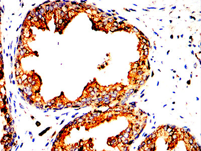 Figure 8:Immunohistochemical analysis of paraffin-embedded prostatic cancer tissues using LAMP1 mouse mAb with DAB staining.