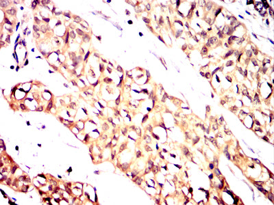 Figure 5:Immunohistochemical analysis of paraffin-embedded bladder cancer tissues using MTDH mouse mAb with DAB staining.