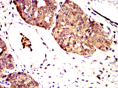 Figure 6:Immunohistochemical analysis of paraffin-embedded ovarian cancer tissues using MTDH mouse mAb with DAB staining.