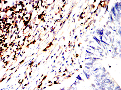 Figure 6:Immunohistochemical analysis of paraffin-embedded rectum cancer tissues using CD45R mouse mAb with DAB staining.