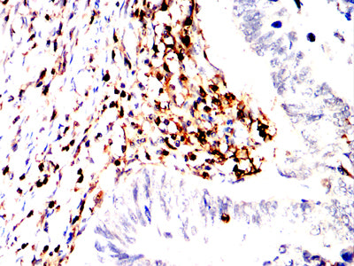 Figure 6:Immunohistochemical analysis of paraffin-embedded rectum cancer tissues using CD45R mouse mAb with DAB staining.