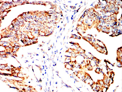 Figure 7:Immunohistochemical analysis of paraffin-embedded rectum cancer tissues using CXCR7 mouse mAb with DAB staining.