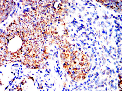 Figure 6:Immunohistochemical analysis of paraffin-embedded cervical cancer tissues using CXCR7 mouse mAb with DAB staining.