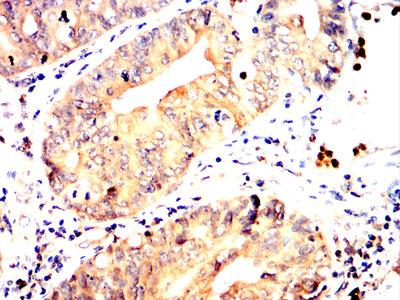 Figure 7:Immunohistochemical analysis of paraffin-embedded rectum cancer tissues using TLT2 mouse mAb with DAB staining.