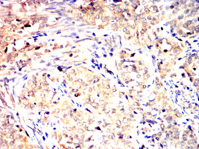 Figure 6:Immunohistochemical analysis of paraffin-embedded cervical cancer tissues using TLT2 mouse mAb with DAB staining.