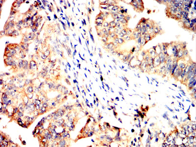 Figure 6:Immunohistochemical analysis of paraffin-embedded rectum cancer tissues using SLC2A14 mouse mAb with DAB staining.