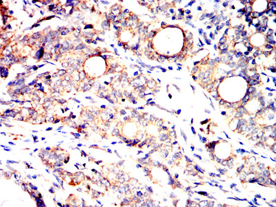 Figure 5:Immunohistochemical analysis of paraffin-embedded cervical cancer tissues using SLC2A14 mouse mAb with DAB staining.