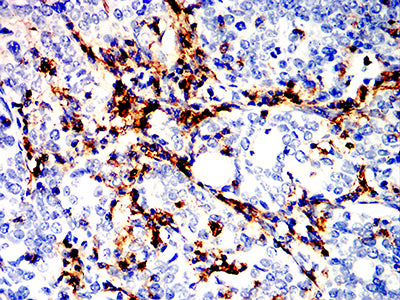 Figure 5:Immunohistochemical analysis of paraffin-embedded cervical carcinoma tissues using CD162 mouse mAb with DAB staining.