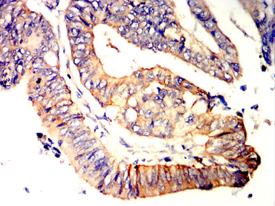 Figure 6:Immunohistochemical analysis of paraffin-embedded rectum cancer tissues using LRRK2 mouse mAb with DAB staining.