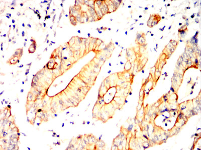Figure 6:Immunohistochemical analysis of paraffin-embedded colon cancer tissues using POU5F1 mouse mAb with DAB staining.