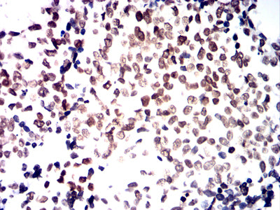 Figure 5:Immunohistochemical analysis of paraffin-embedded bladder cancer tissues using HNF4A mouse mAb with DAB staining.