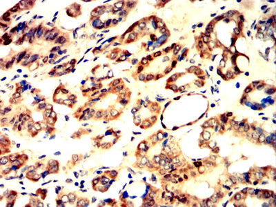 Figure 5:Immunohistochemical analysis of paraffin-embedded thyroid cancer tissues using NPM2 mouse mAb with DAB staining.