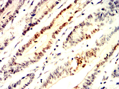 Figure 5:Immunohistochemical analysis of paraffin-embedded colon cancer tissues using MAP4K1 mouse mAb with DAB staining.