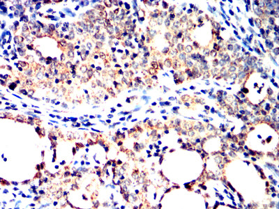 Figure 6:Immunohistochemical analysis of paraffin-embedded cervical cancer tissues using SH2B2 mouse mAb with DAB staining.