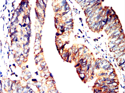 Figure 7:Immunohistochemical analysis of paraffin-embedded rectum cancer tissues using ACAA1 mouse mAb with DAB staining.