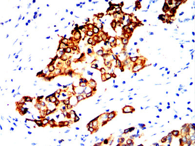 Figure 8:Immunohistochemical analysis of paraffin-embedded esophageal cancer tissues using KRT14 mouse mAb with DAB staining.