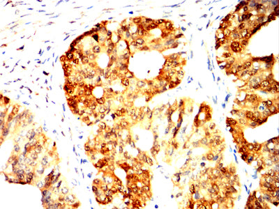 Figure 6:Immunohistochemical analysis of paraffin-embedded ovarian cancer tissues using UCHL1 mouse mAb with DAB staining.