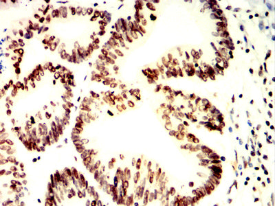 Figure 4:Immunohistochemical analysis of paraffin-embedded colon cancer tissues using H2AFX mouse mAb with DAB staining.