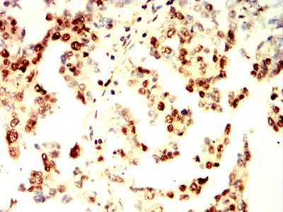 Figure 4:Immunohistochemical analysis of paraffin-embedded ovarian cancer tissues using RAD23B mouse mAb with DAB staining.