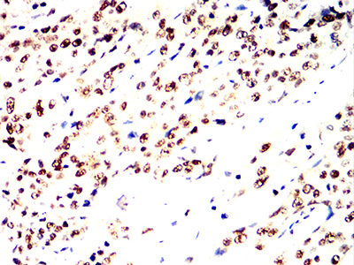 Figure 5:Immunohistochemical analysis of paraffin-embedded esophageal cancer tissues using RFA2 mouse mAb with DAB staining.