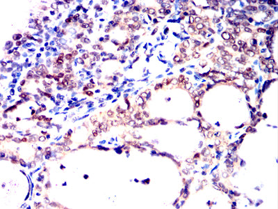 Figure 9:Immunohistochemical analysis of paraffin-embedded cervical cancer tissues using HNF1B mouse mAb with DAB staining.