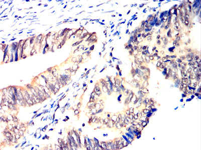 Figure 12:Immunohistochemical analysis of paraffin-embedded rectum cancer tissues using HNF1B mouse mAb with DAB staining.