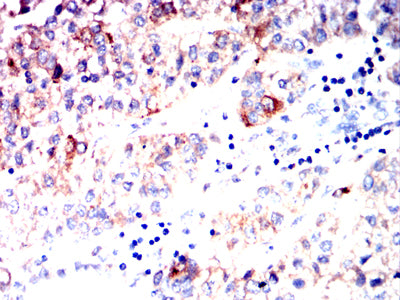 Figure 5:Immunohistochemical analysis of paraffin-embedded liver cancer tissues using AFP mouse mAb with DAB staining.