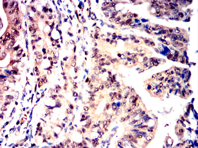 Figure 6:Immunohistochemical analysis of paraffin-embedded rectum cancer tissues using NPM3 mouse mAb with DAB staining.