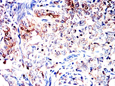 Figure 5:Immunohistochemical analysis of paraffin-embedded cervical cancer tissues using S100A4 mouse mAb with DAB staining.