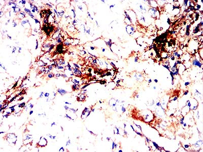 Figure 6:Immunohistochemical analysis of paraffin-embedded lung cancer tissues using TPSAB1 mouse mAb with DAB staining.