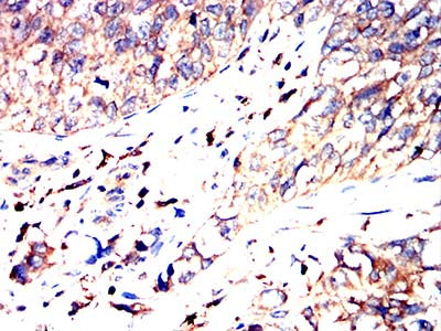 Figure 7:Immunohistochemical analysis of paraffin-embedded bladder cancer tissues using C9orf72 mouse mAb with DAB staining.