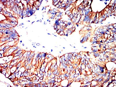 Figure 7:Immunohistochemical analysis of paraffin-embedded colon cancer tissues using MRP3 mouse mAb with DAB staining.