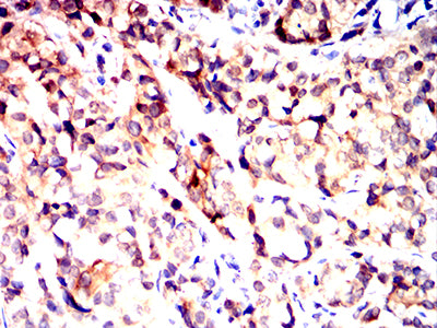 Figure 6:Immunohistochemical analysis of paraffin-embedded bladder cancer tissues using UCHL1 mouse mAb with DAB staining.