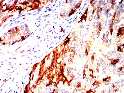 Figure 8:Immunohistochemical analysis of paraffin-embedded cervical cancer tissues using UCHL1 mouse mAb with DAB staining.