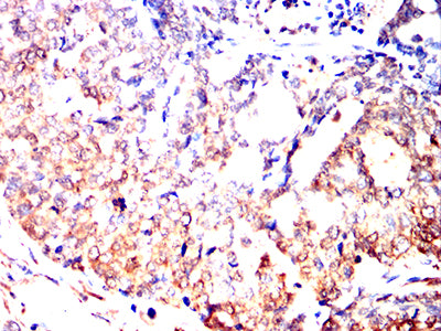 Figure 9:Immunohistochemical analysis of paraffin-embedded esophageal cancer tissues using UCHL1 mouse mAb with DAB staining.