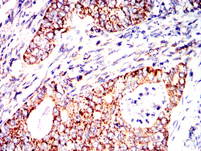 Figure 9:Immunohistochemical analysis of paraffin-embedded cervical cancer tissues using IRF3 mouse mAb with DAB staining.