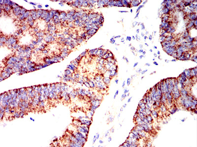 Figure 10:Immunohistochemical analysis of paraffin-embedded colon cancer tissues using IRF3 mouse mAb with DAB staining.