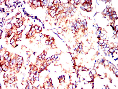 Figure 8:Immunohistochemical analysis of paraffin-embedded lung cancer tissues using PDHA1 mouse mAb with DAB staining.