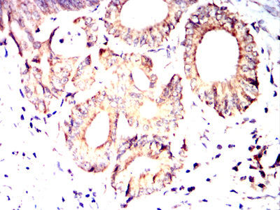 Figure 11:Immunohistochemical analysis of paraffin-embedded colon cancer tissues using PDHA1 mouse mAb with DAB staining.