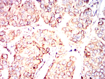 Figure 12:Immunohistochemical analysis of paraffin-embedded breast cancer tissues using PDHA1 mouse mAb with DAB staining.