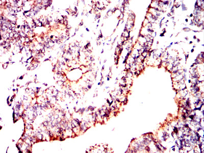 Figure 10:Immunohistochemical analysis of paraffin-embedded lung cancer tissues using PDHA1 mouse mAb with DAB staining.