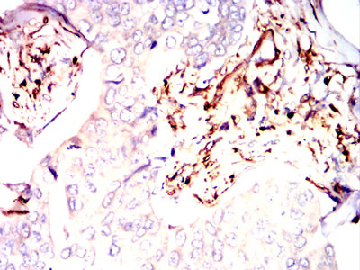 Figure 5:Immunohistochemical analysis of paraffin-embedded breast cancer tissues using S100A4 mouse mAb with DAB staining.