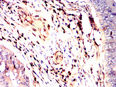 Figure 6:Immunohistochemical analysis of paraffin-embedded rectum cancer tissues using S100A4 mouse mAb with DAB staining.