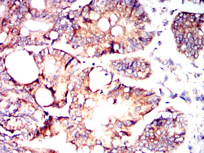 Figure 7:Immunohistochemical analysis of paraffin-embedded rectum cancer tissues using ZP2 mouse mAb with DAB staining.