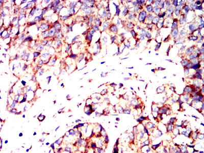 Figure 5:Immunohistochemical analysis of paraffin-embedded human bladder cancer tissues using IRF3 mouse mAb with DAB staining.