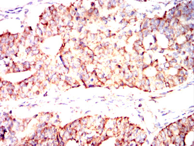 Figure 7:Immunohistochemical analysis of paraffin-embedded human ovarian cancer tissues using IRF3 mouse mAb with DAB staining.