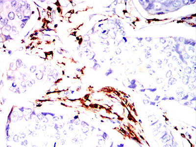 Figure 7:Immunohistochemical analysis of paraffin-embedded breast cancer tissues using HLA-DPA1 mouse mAb with DAB staining.